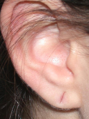 Ear Repair Torn Gauged Earlobe Houston Tx Stretched Hole From An Earring Not Completely Torn Through