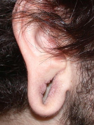 Ear Repair Torn Gauged Earlobe Houston Tx Someone Who Wore Gauged Earrings Before And Now Wants A Normal Earlobe