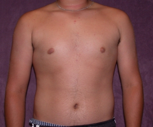 gynecomastia male breast teens Gynecomastia male breast teens