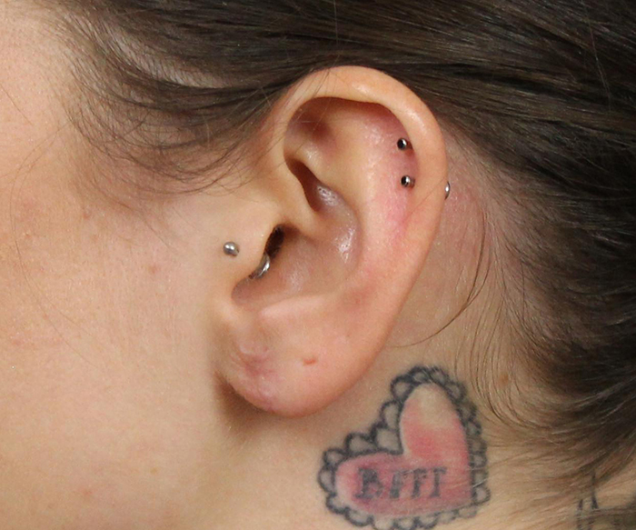 Ear Repair Torn Gauged Earlobe Houston Tx View The Gallery