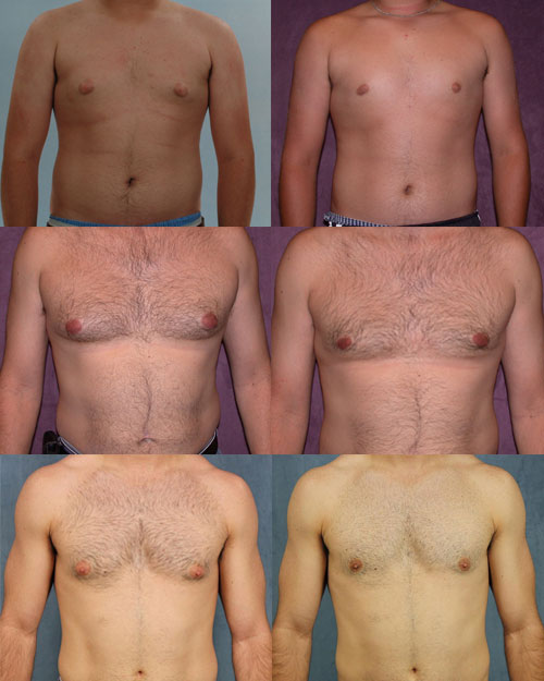 male breast reduction before and afters