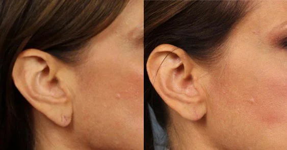 Torn Earlobe Repair Los Angeles | Keloid Removal Beverly Hills