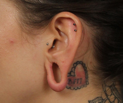 Ear Repair Torn Gauged Earlobe Houston TX