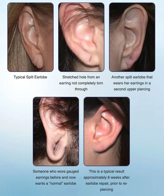 Earlobe Repair Surgery | Miami, FL | Dr. Bared